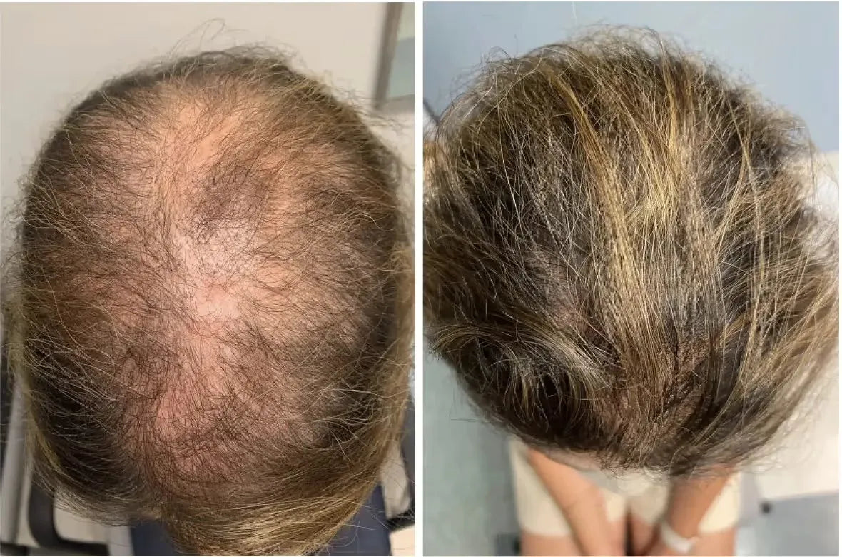 Zephta® H-Regrow 2.0