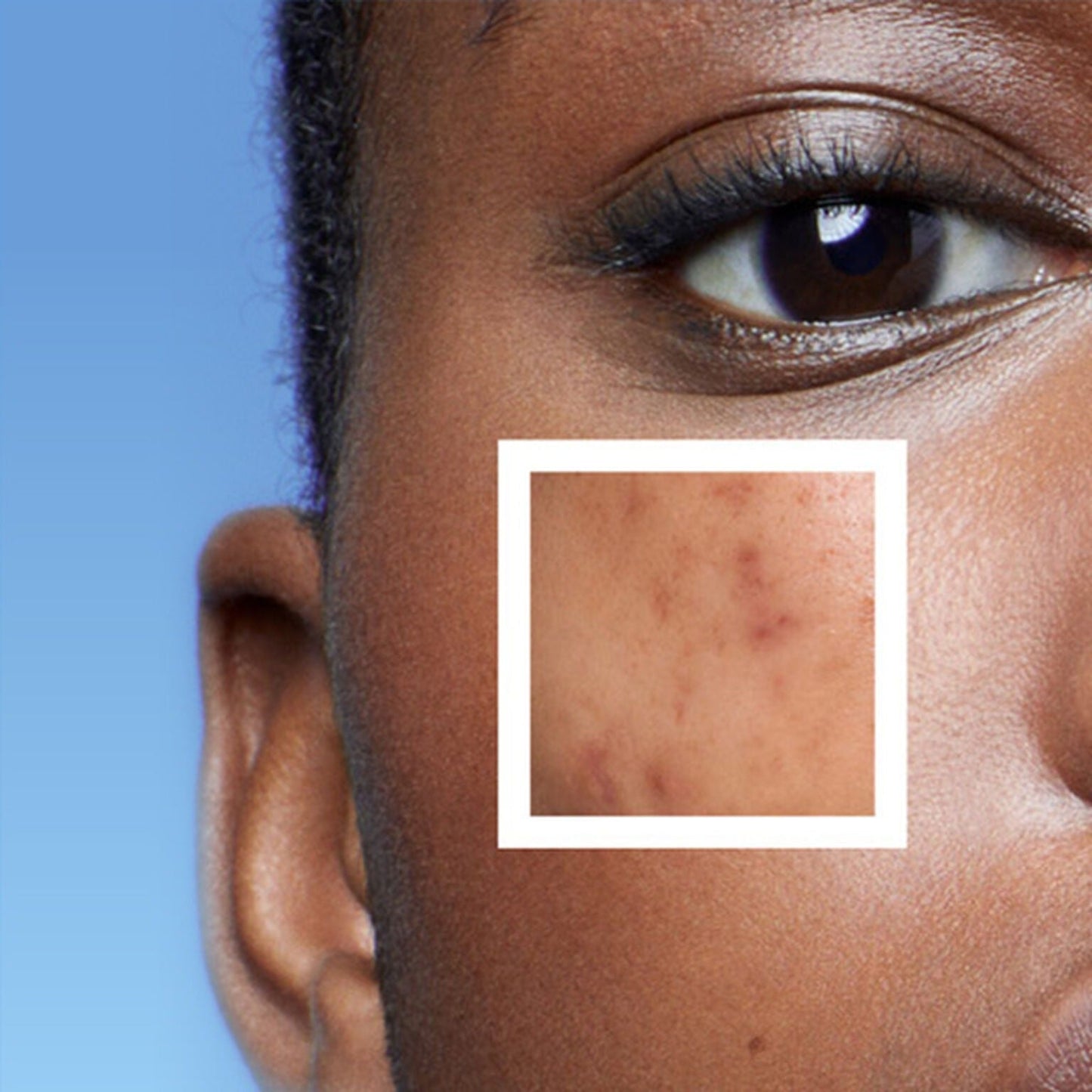 Effaclar Duo Acne Spot Treatment